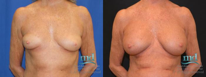 Before & After Breast Augmentation Case 64 View #1 View in Melbourne, FL