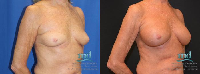 Before & After Breast Augmentation Case 64 View #2 View in Melbourne, FL