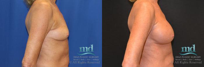 Before & After Breast Augmentation Case 64 View #3 View in Melbourne, FL