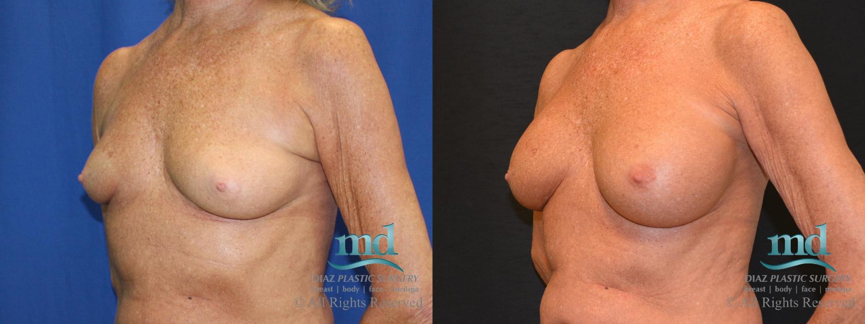 Before & After Breast Augmentation Case 64 View #4 View in Melbourne, FL