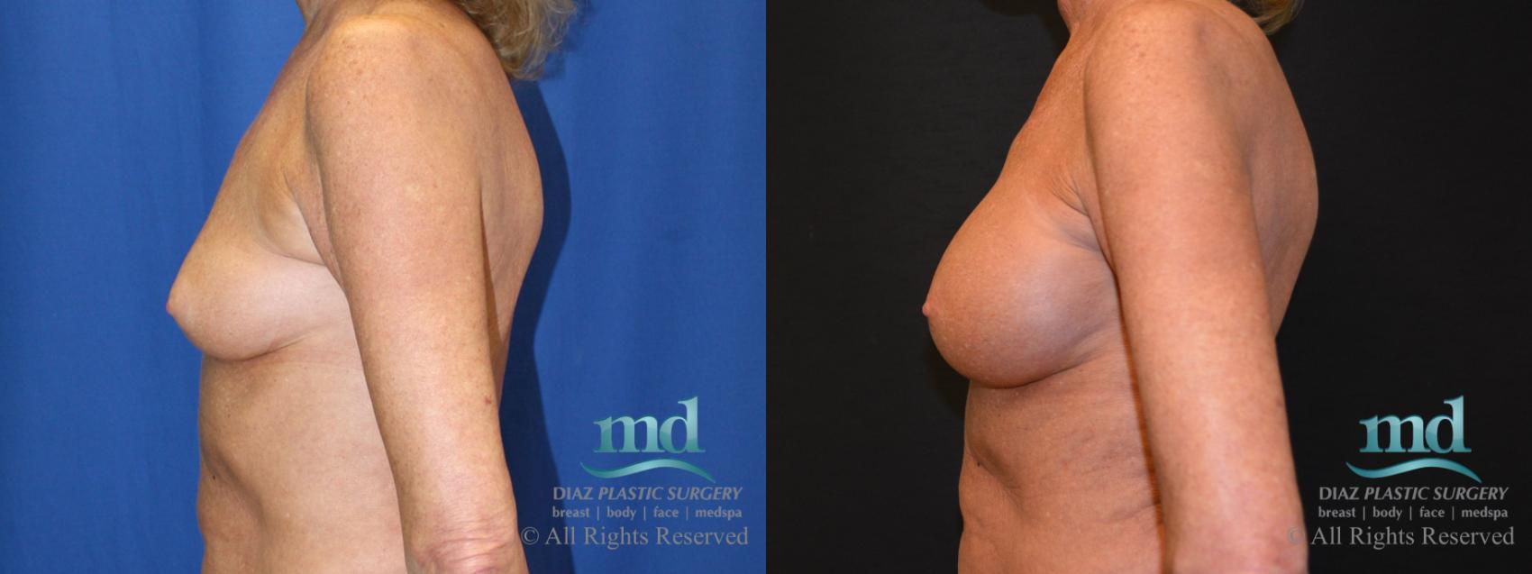Before & After Breast Augmentation Case 64 View #5 View in Melbourne, FL