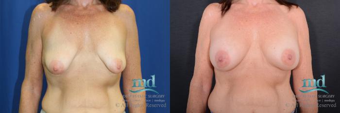Before & After Breast Augmentation Case 65 View #1 View in Melbourne, FL
