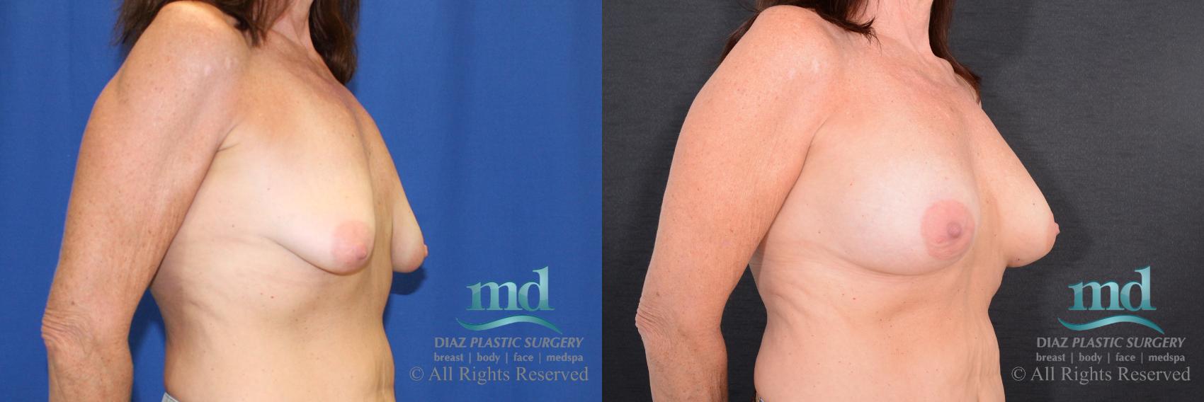 Before & After Breast Augmentation Case 65 View #2 View in Melbourne, FL