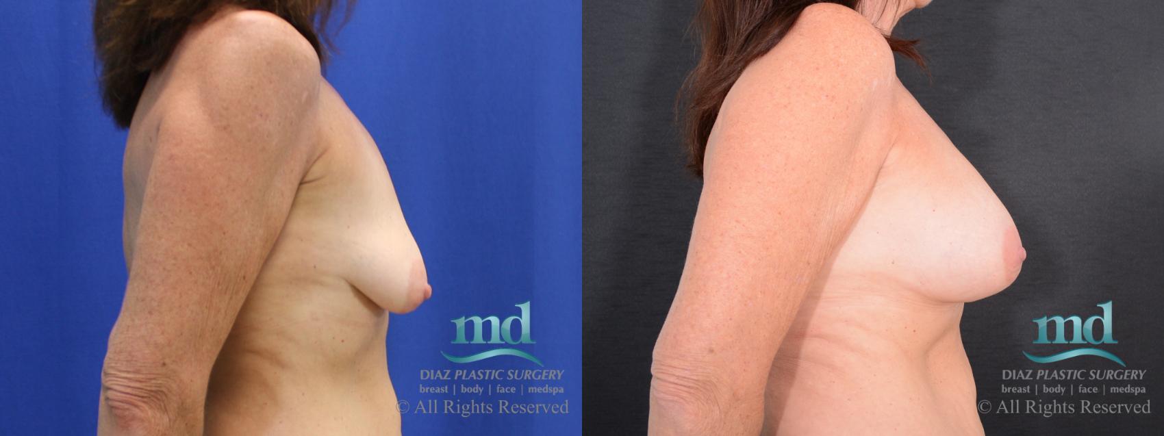 Before & After Breast Augmentation Case 65 View #3 View in Melbourne, FL