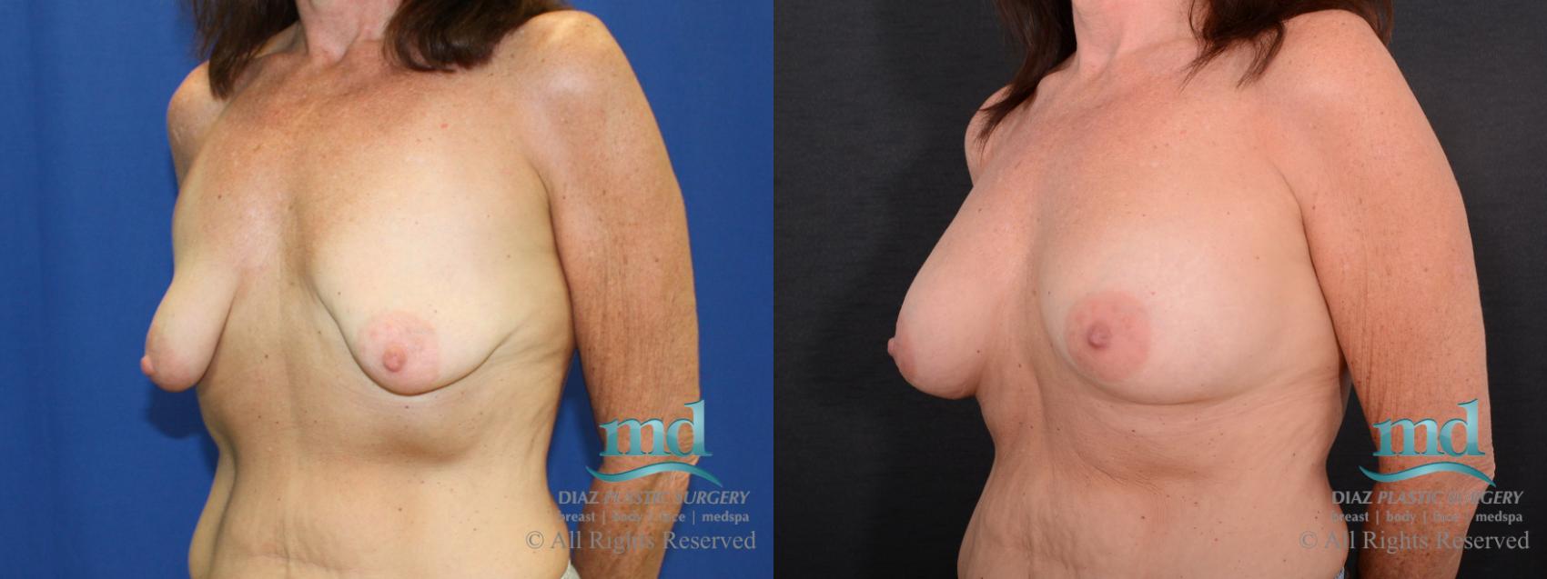 Before & After Breast Augmentation Case 65 View #4 View in Melbourne, FL