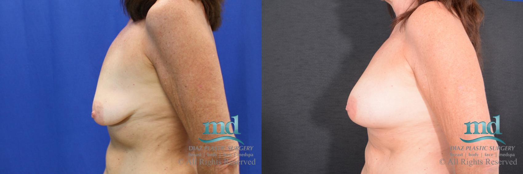 Before & After Breast Augmentation Case 65 View #5 View in Melbourne, FL
