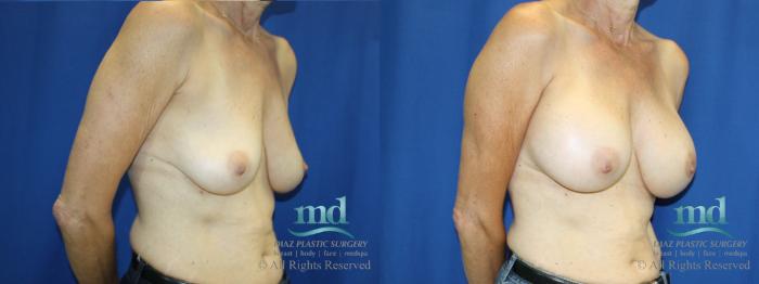 Before & After Breast Augmentation Case 66 View #2 View in Melbourne, FL