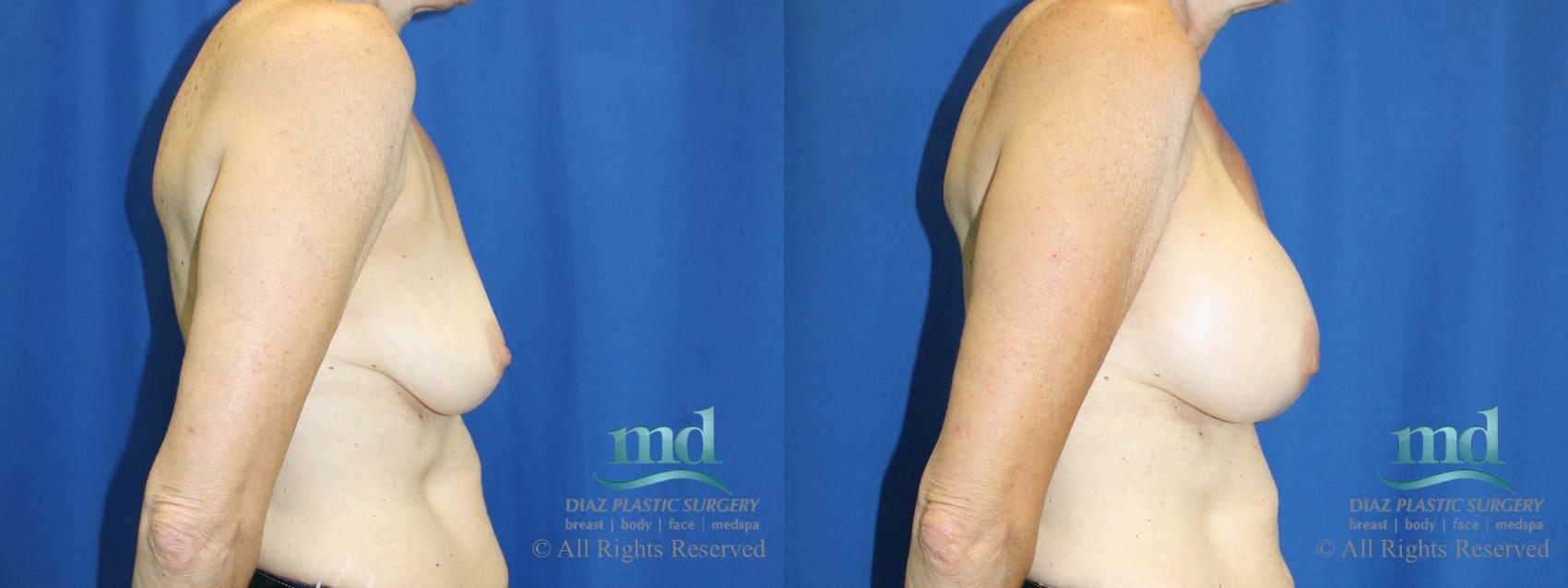 Before & After Breast Augmentation Case 66 View #3 View in Melbourne, FL