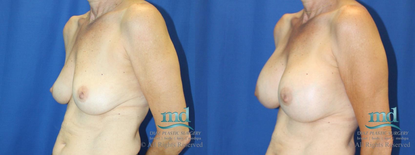 Before & After Breast Augmentation Case 66 View #4 View in Melbourne, FL
