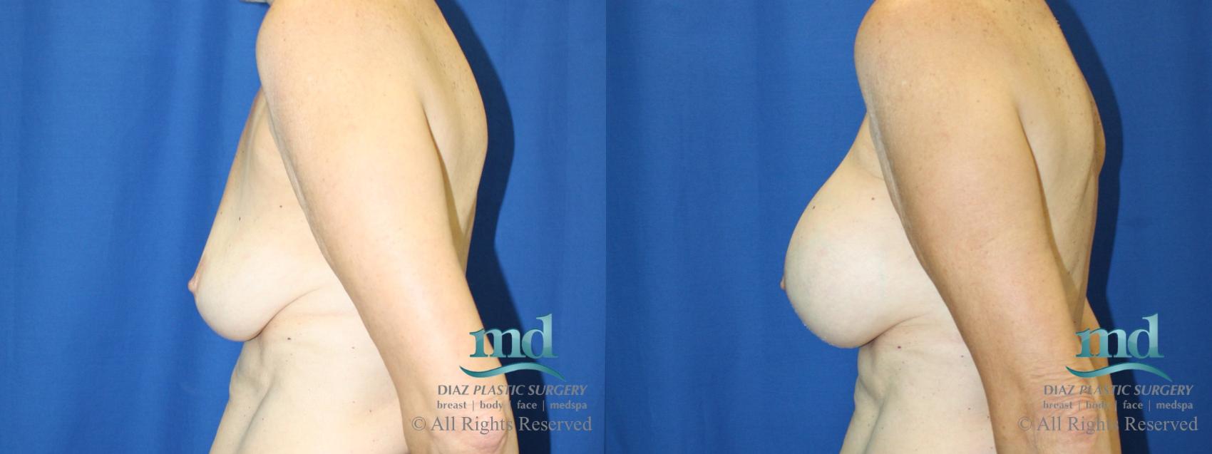 Before & After Breast Augmentation Case 66 View #5 View in Melbourne, FL