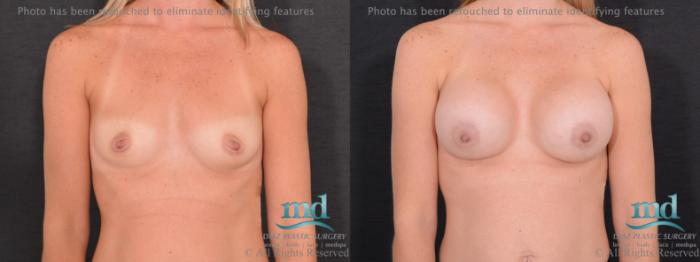 Before & After Breast Augmentation Case 67 View #1 View in Melbourne, FL