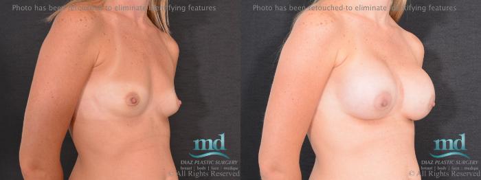 Before & After Breast Augmentation Case 67 View #2 View in Melbourne, FL