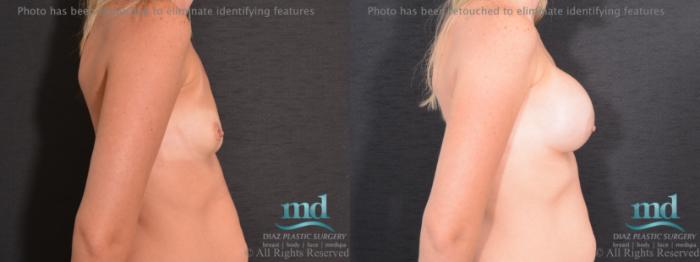 Before & After Breast Augmentation Case 67 View #3 View in Melbourne, FL