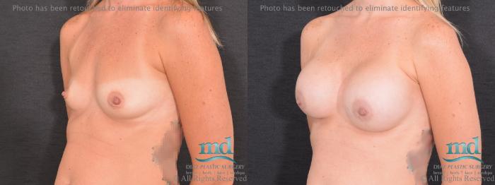 Before & After Breast Augmentation Case 67 View #4 View in Melbourne, FL