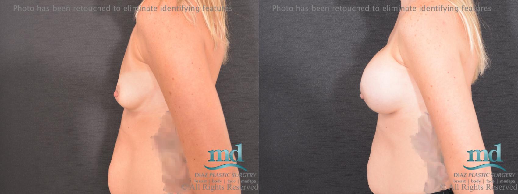 Before & After Breast Augmentation Case 67 View #5 View in Melbourne, FL