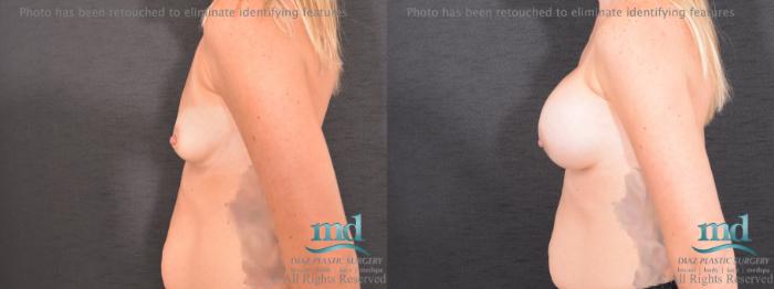 Before & After Breast Augmentation Case 67 View #5 View in Melbourne, FL