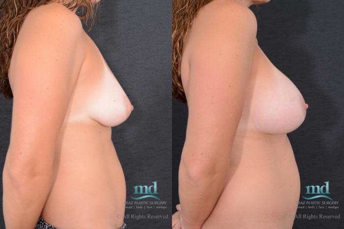 Before & After Breast Augmentation Case 68 View #3 View in Melbourne, FL