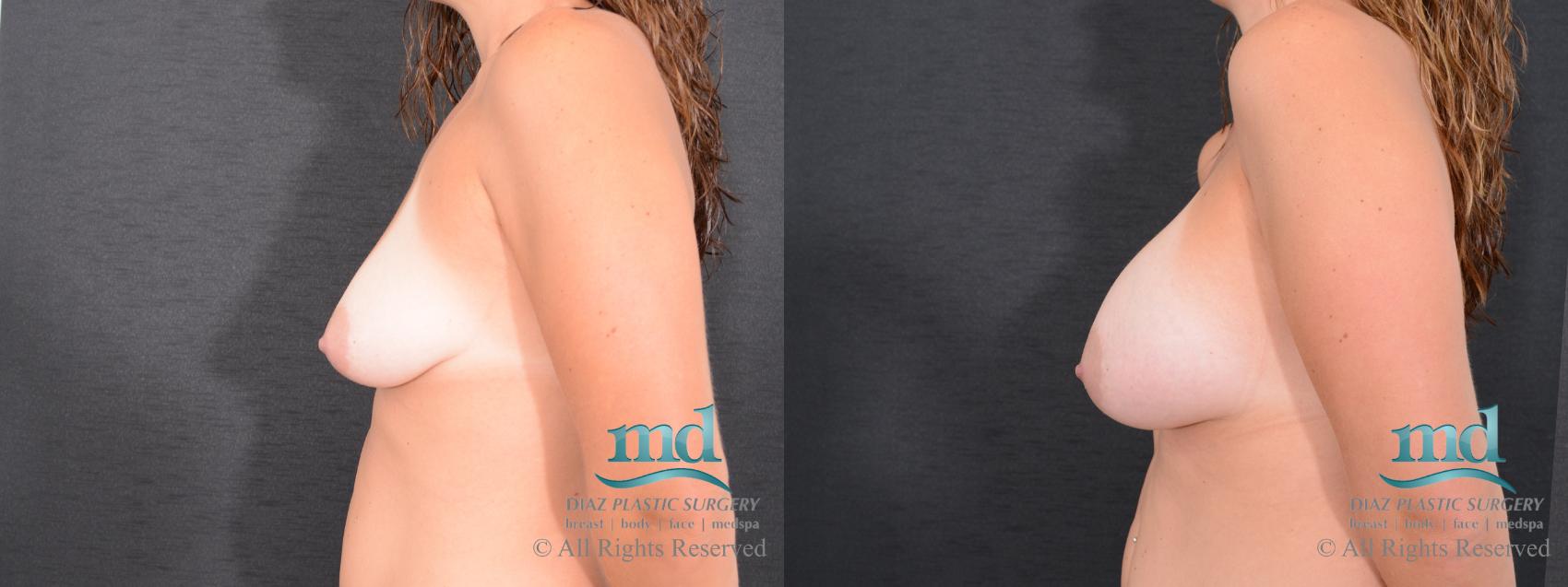 Before & After Breast Augmentation Case 68 View #5 View in Melbourne, FL