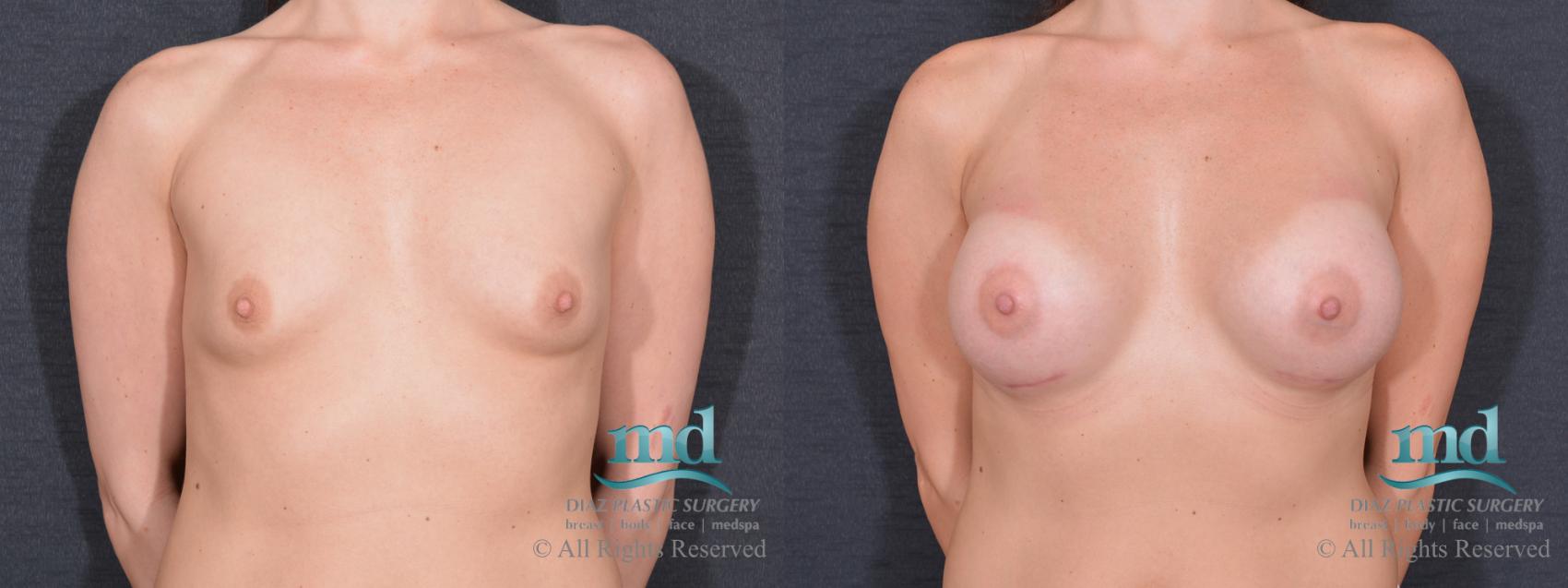 Before & After Breast Augmentation Case 69 View #1 View in Melbourne, FL