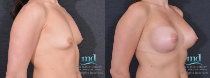 Before & After Breast Augmentation Case 69 View #2 View in Melbourne, FL