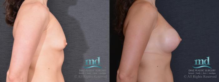 Before & After Breast Augmentation Case 69 View #3 View in Melbourne, FL