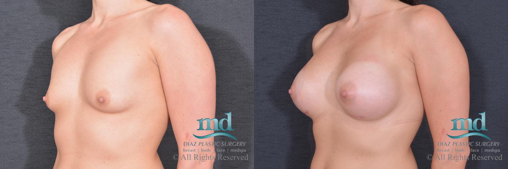 Before & After Breast Augmentation Case 69 View #4 View in Melbourne, FL