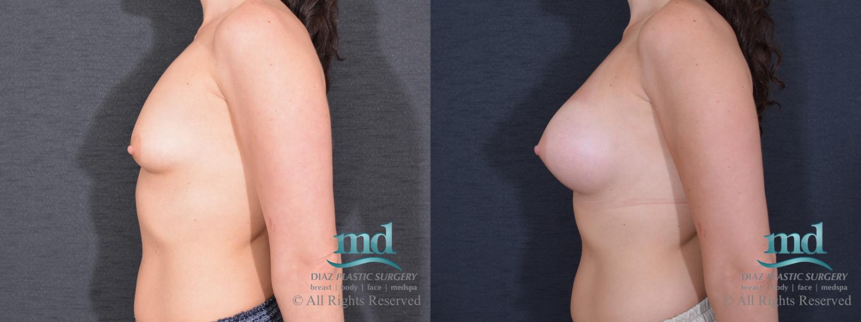 Before & After Breast Augmentation Case 69 View #5 View in Melbourne, FL