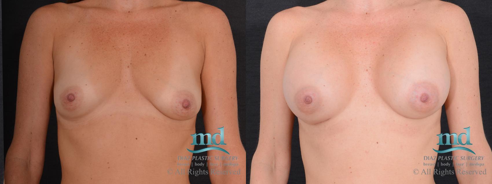 Before & After Breast Augmentation Case 70 View #1 View in Melbourne, FL