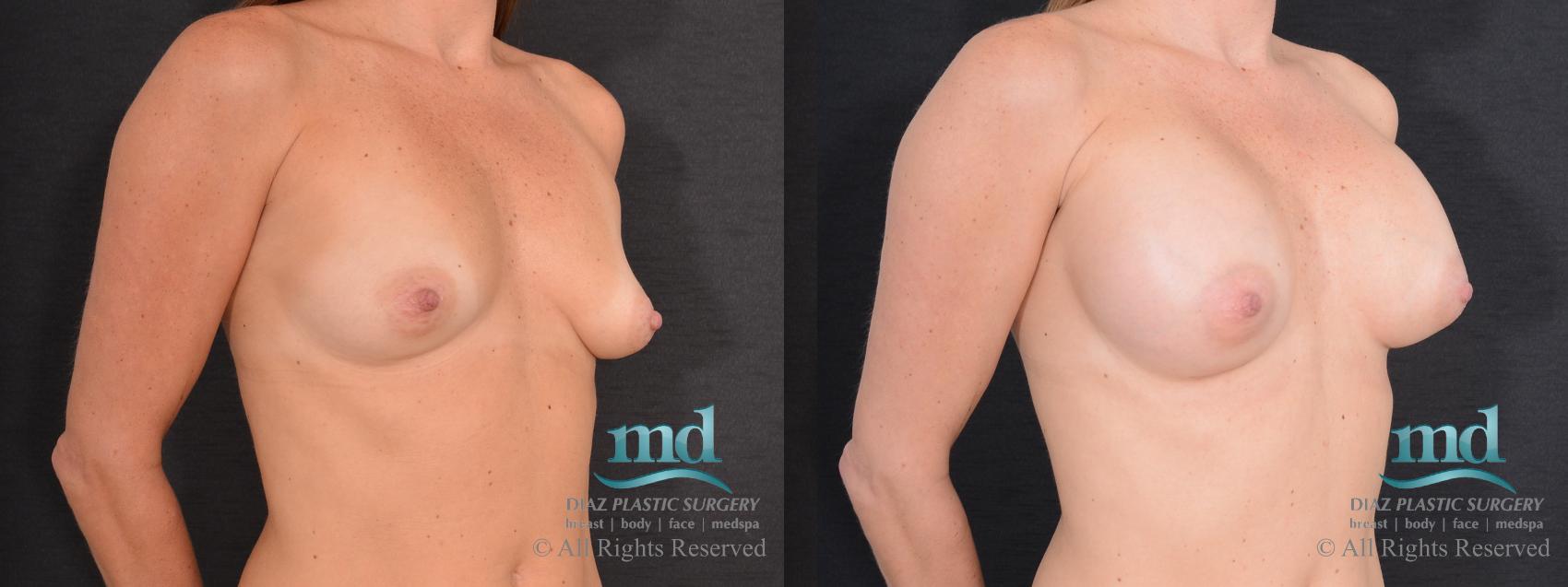 Before & After Breast Augmentation Case 70 View #2 View in Melbourne, FL