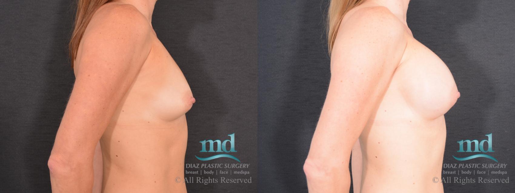 Before & After Breast Augmentation Case 70 View #3 View in Melbourne, FL