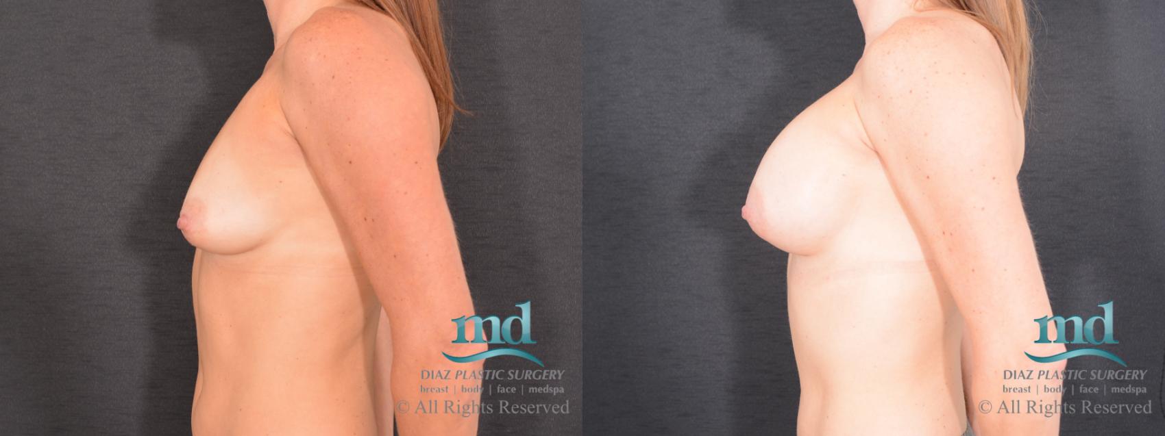 Before & After Breast Augmentation Case 70 View #5 View in Melbourne, FL