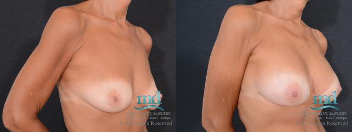 Before & After Breast Augmentation Case 71 View #2 View in Melbourne, FL