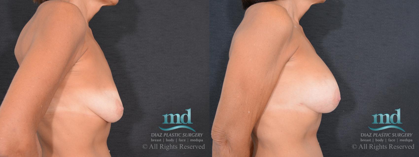 Before & After Breast Augmentation Case 71 View #3 View in Melbourne, FL