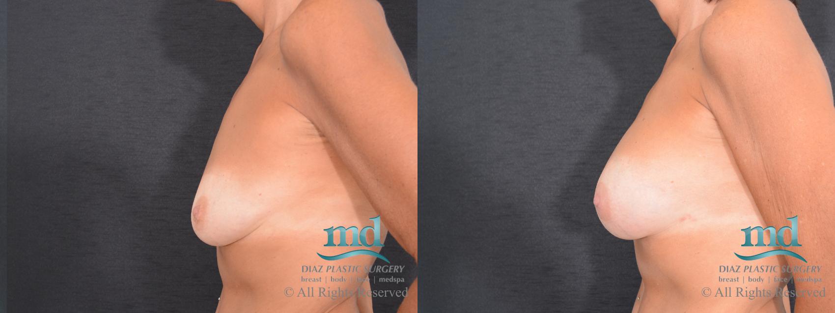 Before & After Breast Augmentation Case 71 View #5 View in Melbourne, FL