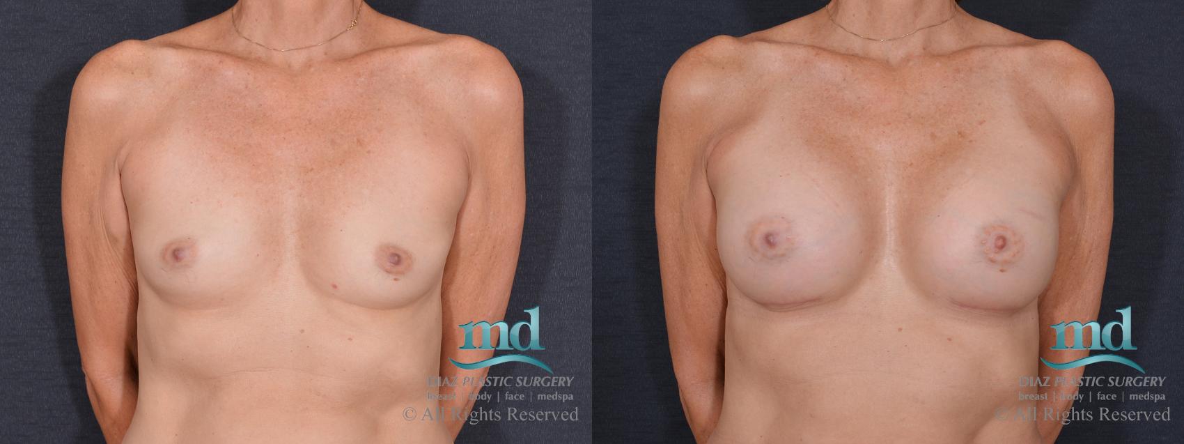 Before & After Breast Augmentation Case 73 View #1 View in Melbourne, FL