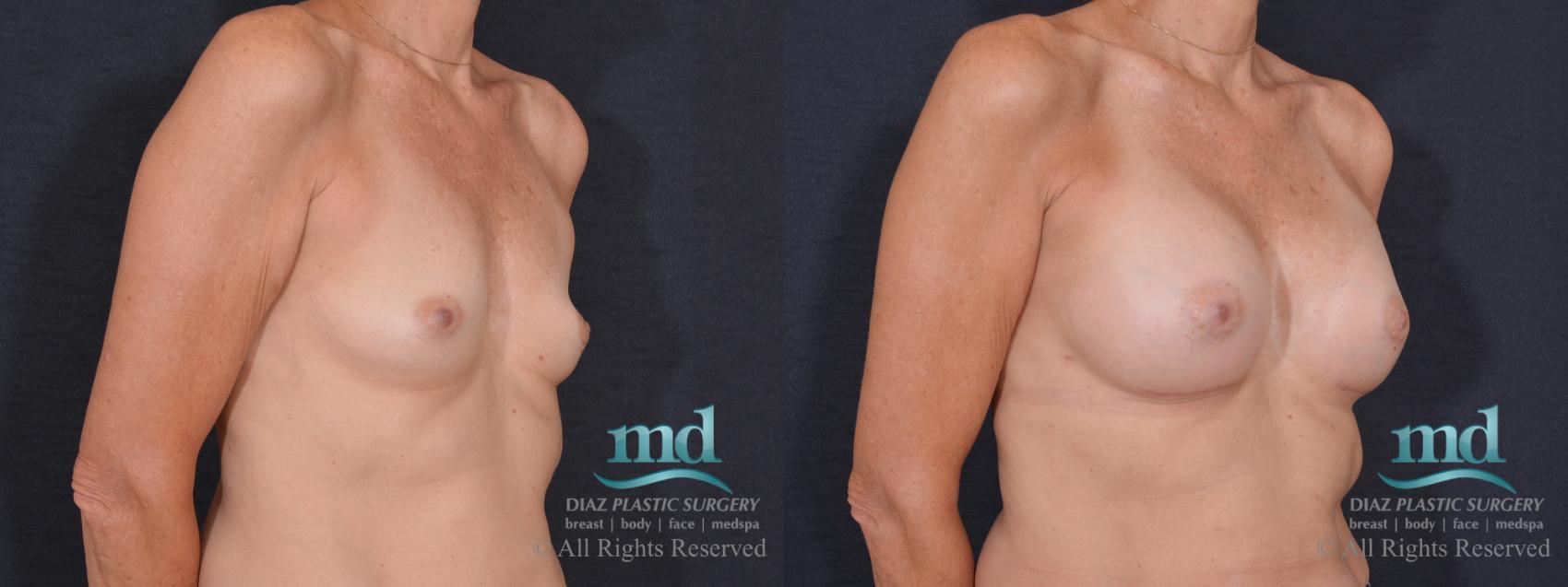 Before & After Breast Augmentation Case 73 View #2 View in Melbourne, FL