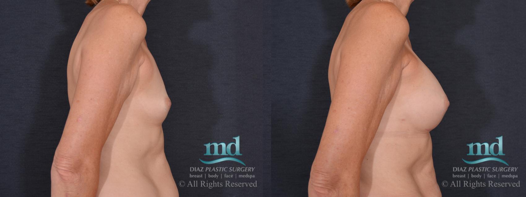 Before & After Breast Augmentation Case 73 View #3 View in Melbourne, FL