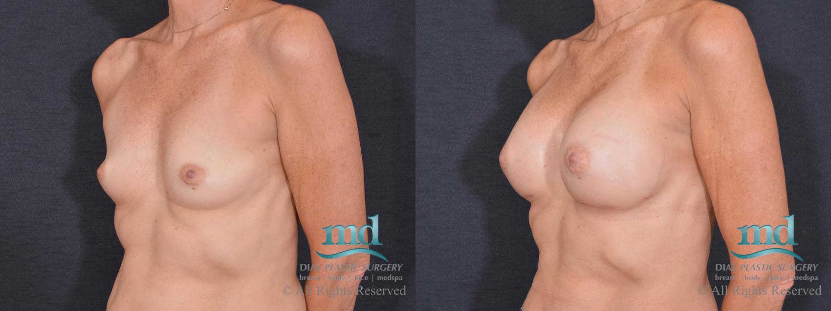 Before & After Breast Augmentation Case 73 View #4 View in Melbourne, FL