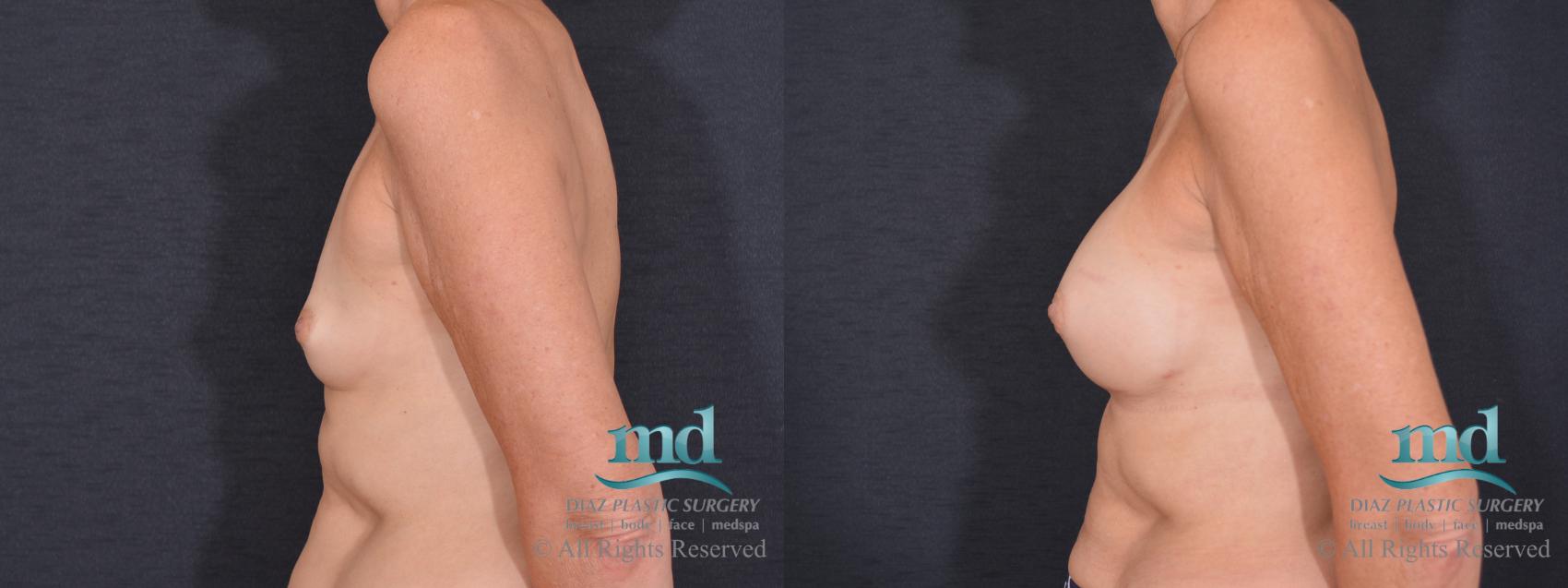 Before & After Breast Augmentation Case 73 View #5 View in Melbourne, FL