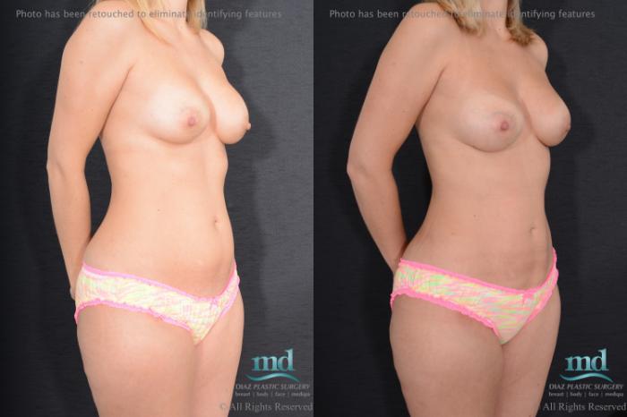 Before & After Breast Augmentation Case 97 View #2 View in Melbourne, FL