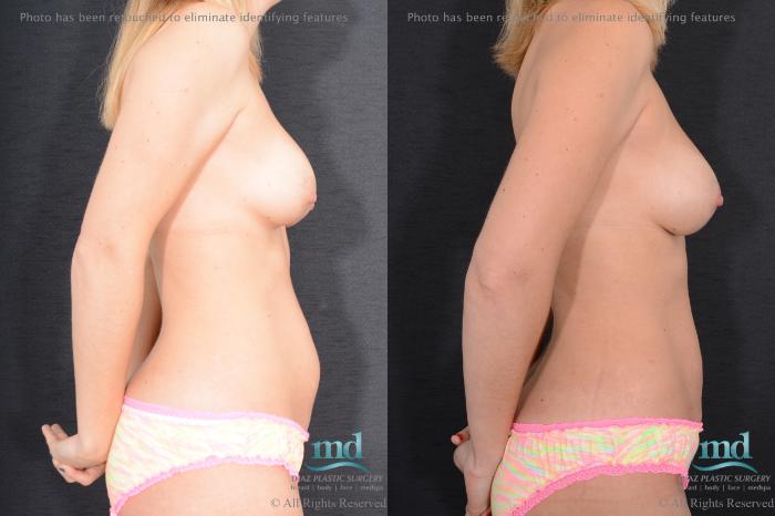 Before & After Breast Augmentation Case 97 View #3 View in Melbourne, FL