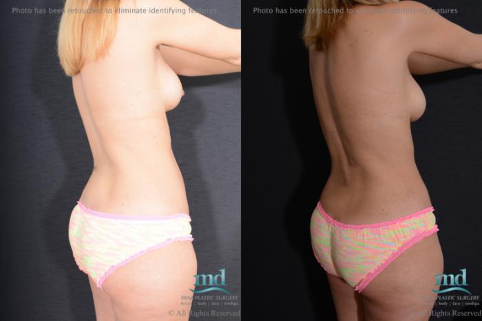 Before & After Breast Augmentation Case 97 View #4 View in Melbourne, FL