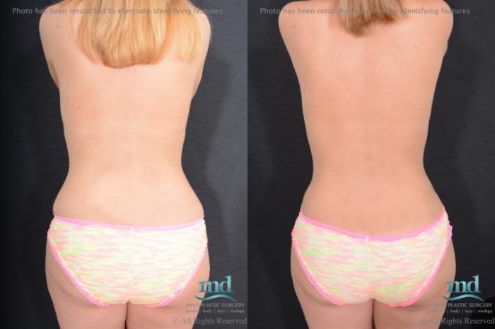 Before & After Breast Augmentation Case 97 View #5 View in Melbourne, FL