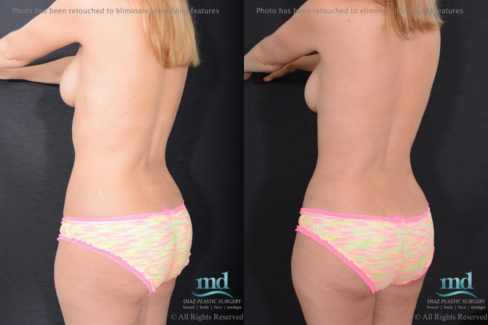 Before & After Breast Augmentation Case 97 View #6 View in Melbourne, FL