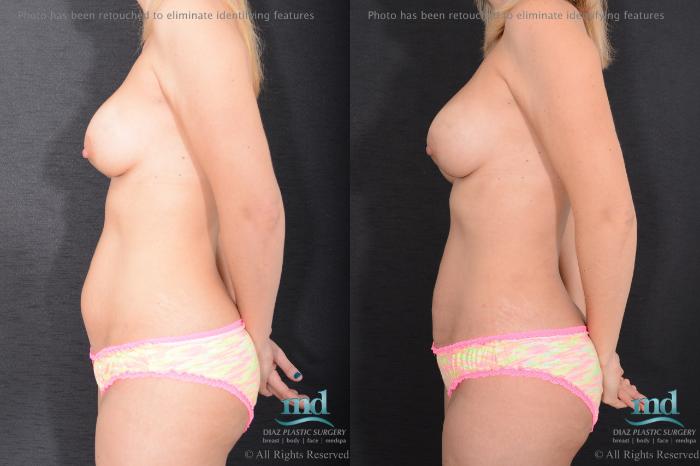 Before & After Breast Augmentation Case 97 View #7 View in Melbourne, FL