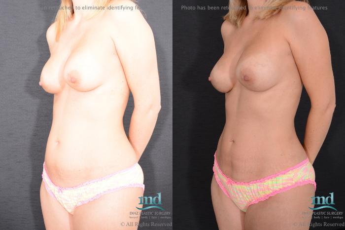 Before & After Breast Augmentation Case 97 View #8 View in Melbourne, FL