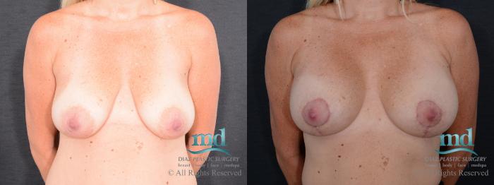 Before & After Breast Lift Case 127 View #1 View in Melbourne, FL