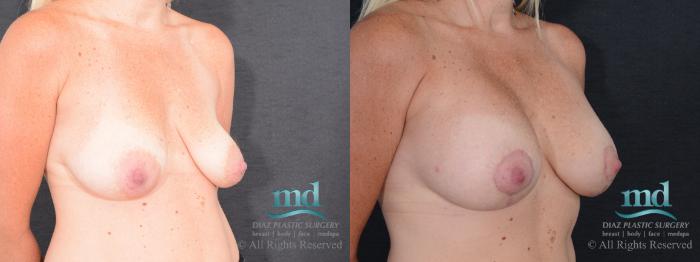 Before & After Breast Lift Case 127 View #2 View in Melbourne, FL