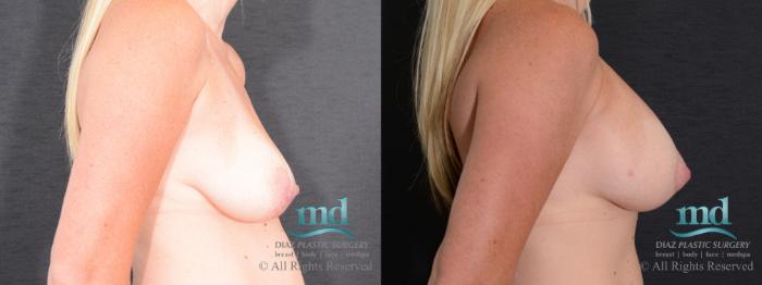 Before & After Breast Lift Case 127 View #3 View in Melbourne, FL