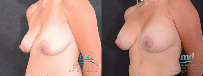 Before & After Breast Lift Case 127 View #4 View in Melbourne, FL